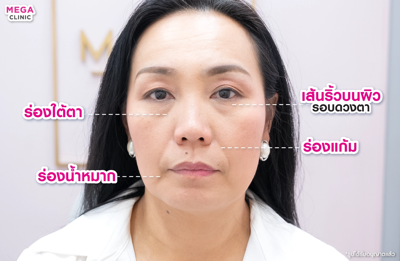 ริ้วรอยบนใบหน้า