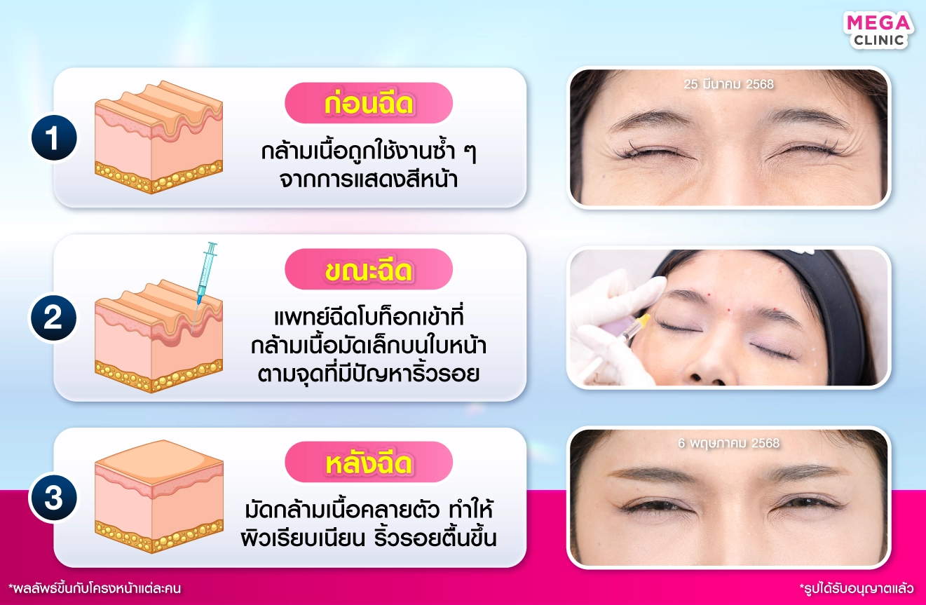 โบท็อก ช่วยอะไร