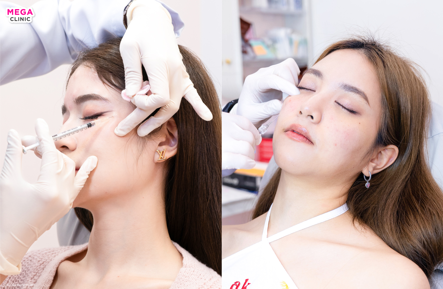 ฉีดโบท็อกและฟิลเลอร์