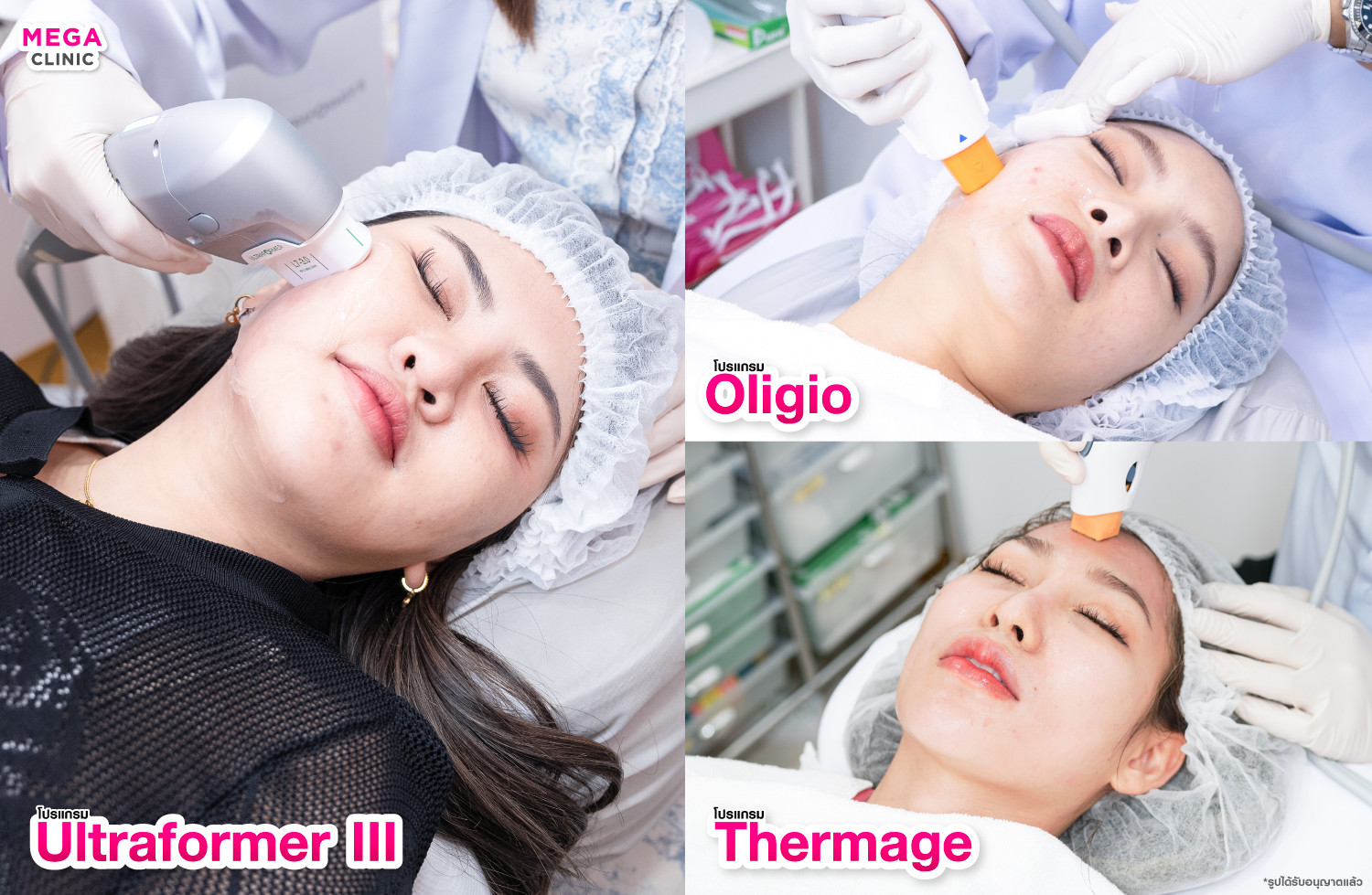 เครื่องยกกระชับ Ultraformer III Oligio Thermage