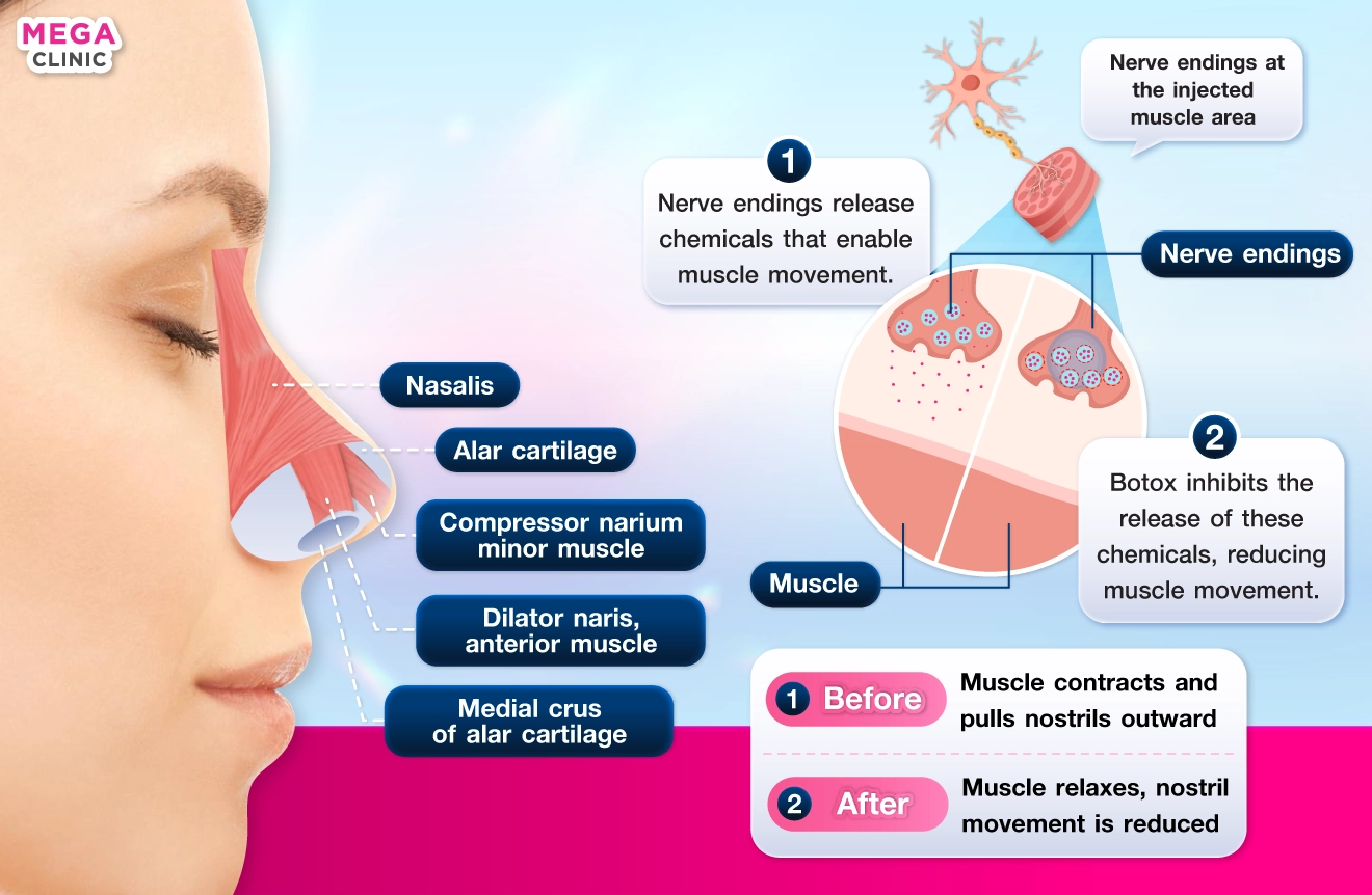 How does nasal flare Botox help?