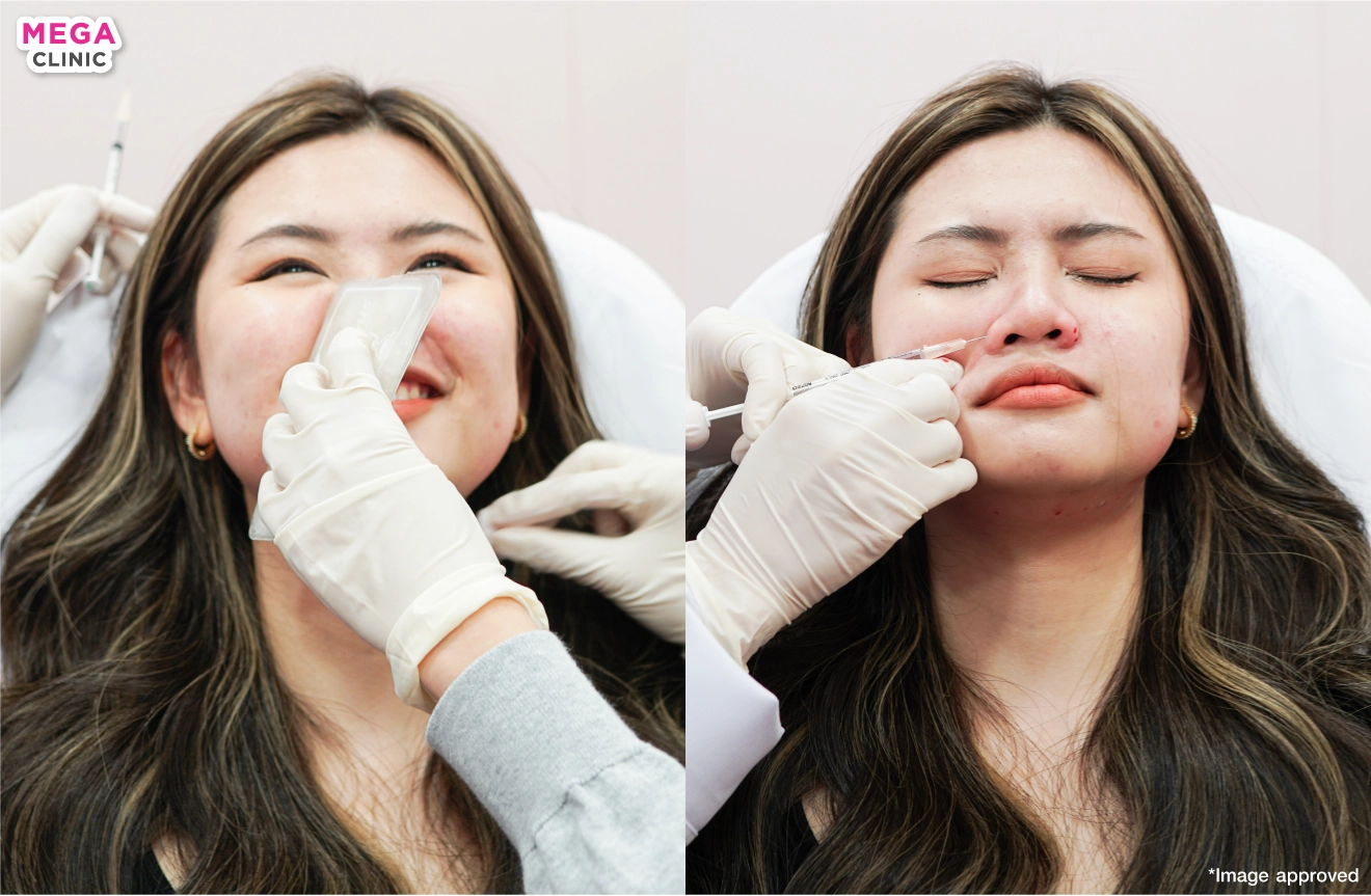 ฉีดโบท็อกปีกจมูก