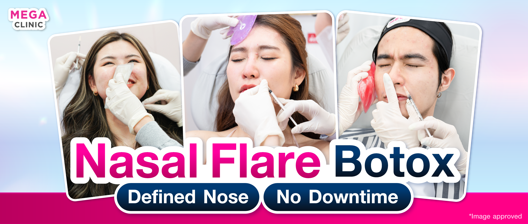 What is nasal flare Botox?