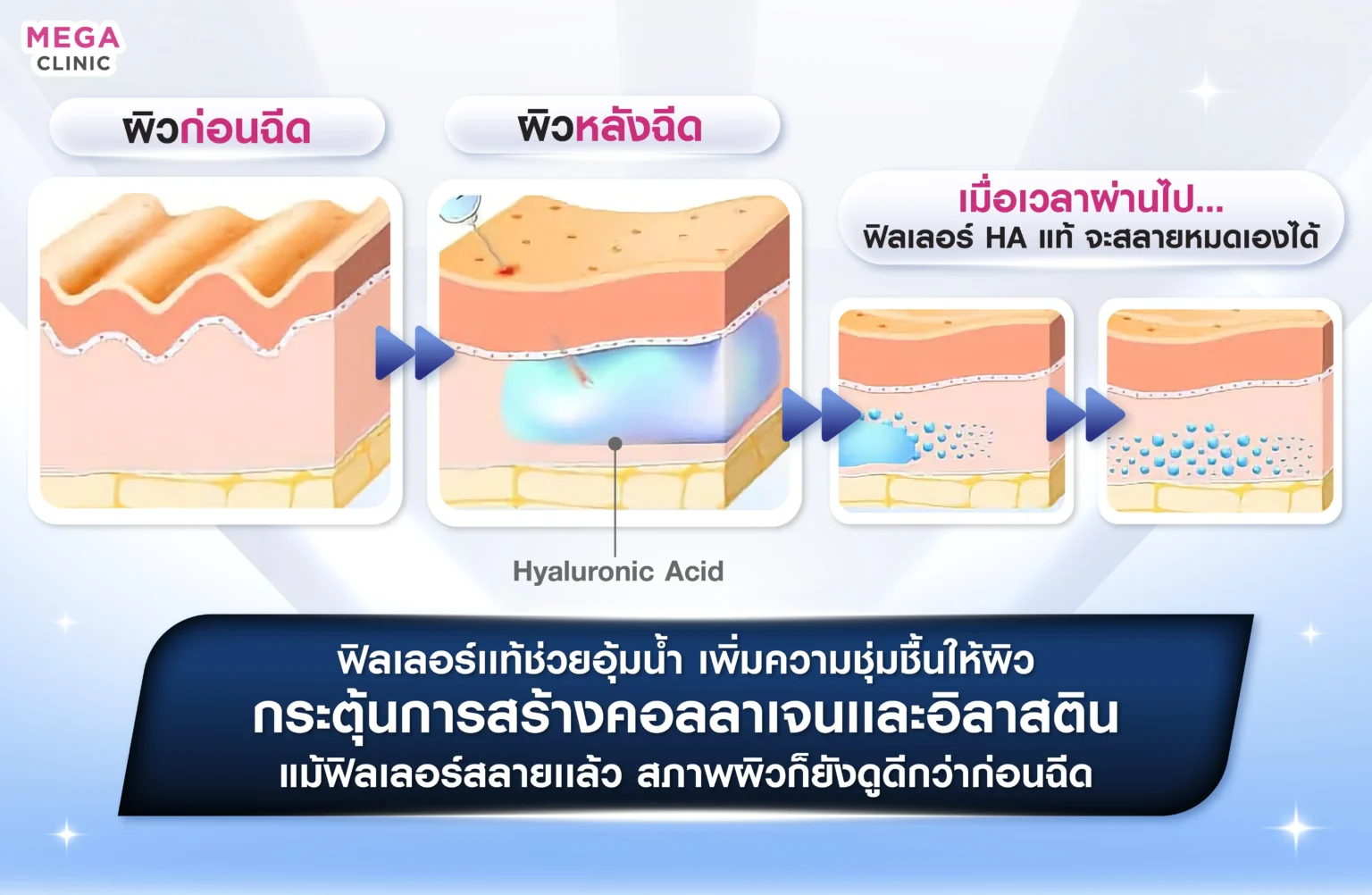 ฟิลเลอร์ คืออะไร