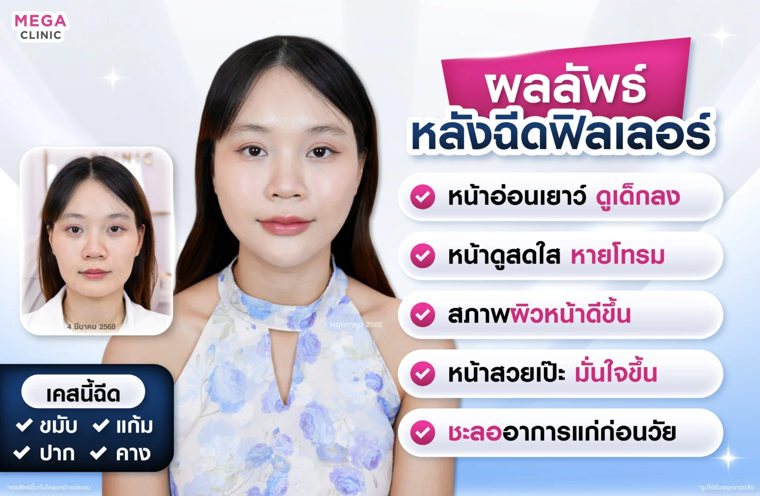 ผลลัพธ์หลังฉีดฟิลเลอร์