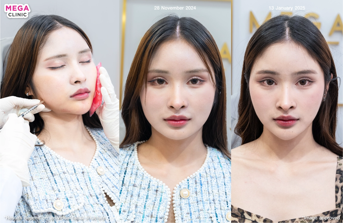 รีวิวโบท็อกลดกราม