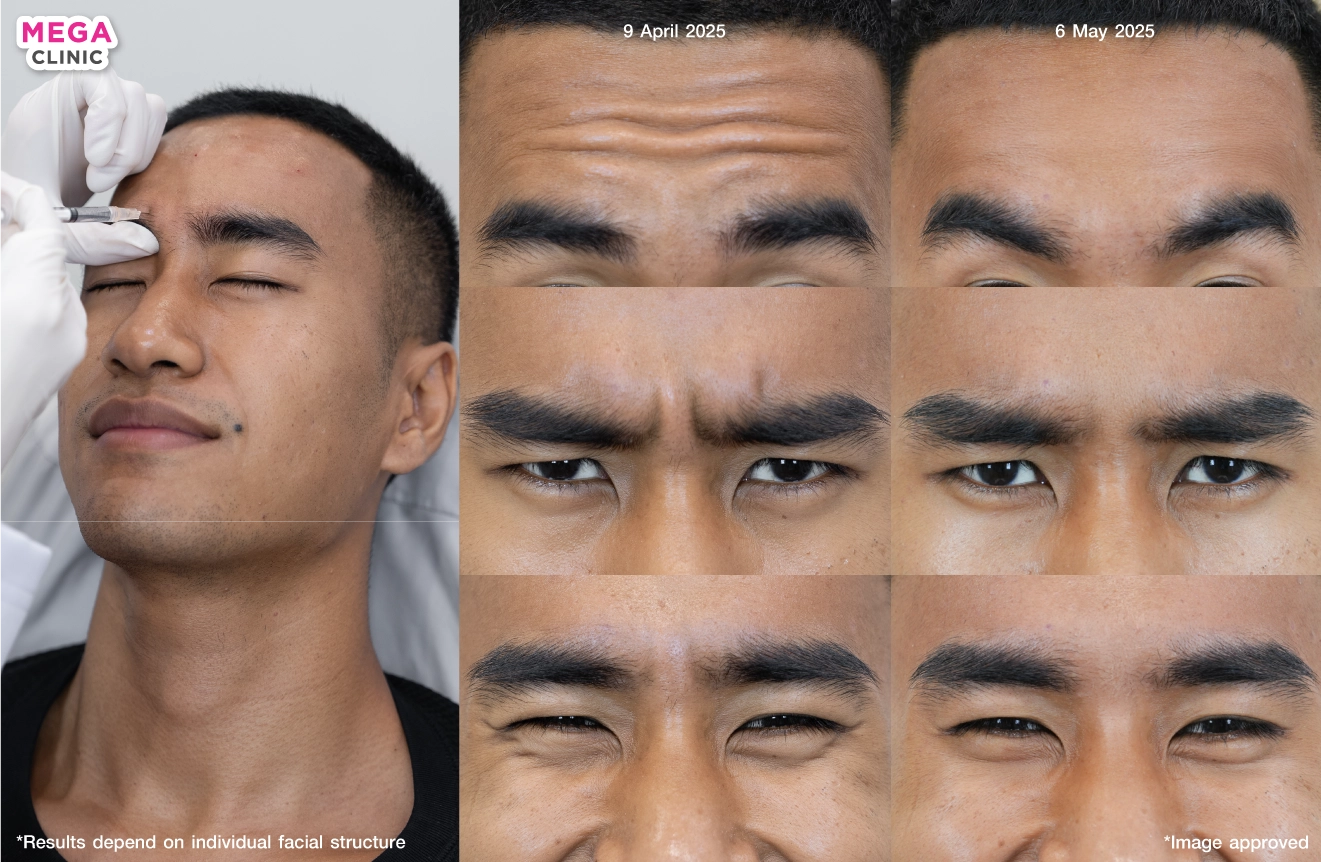Botox for wrinkles
