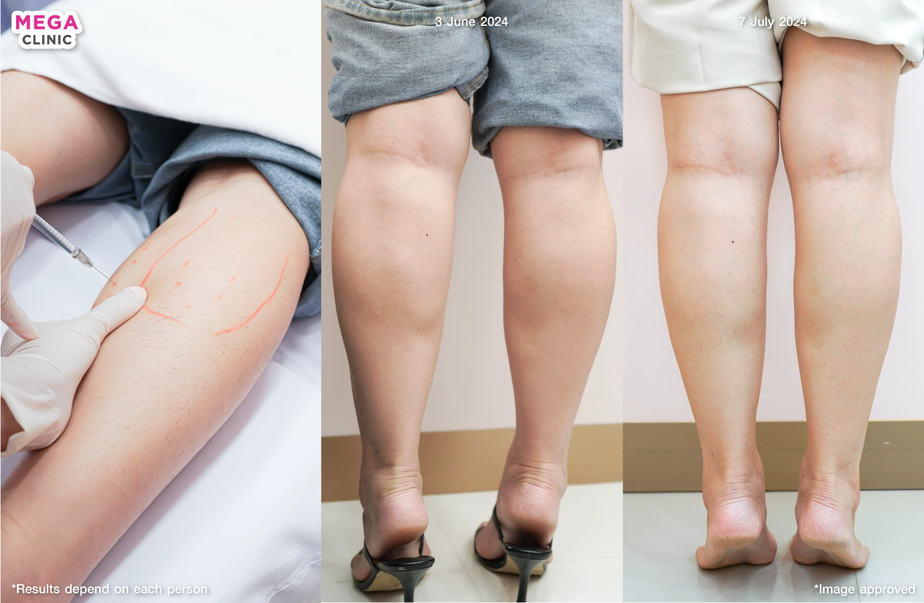 Calf Botox