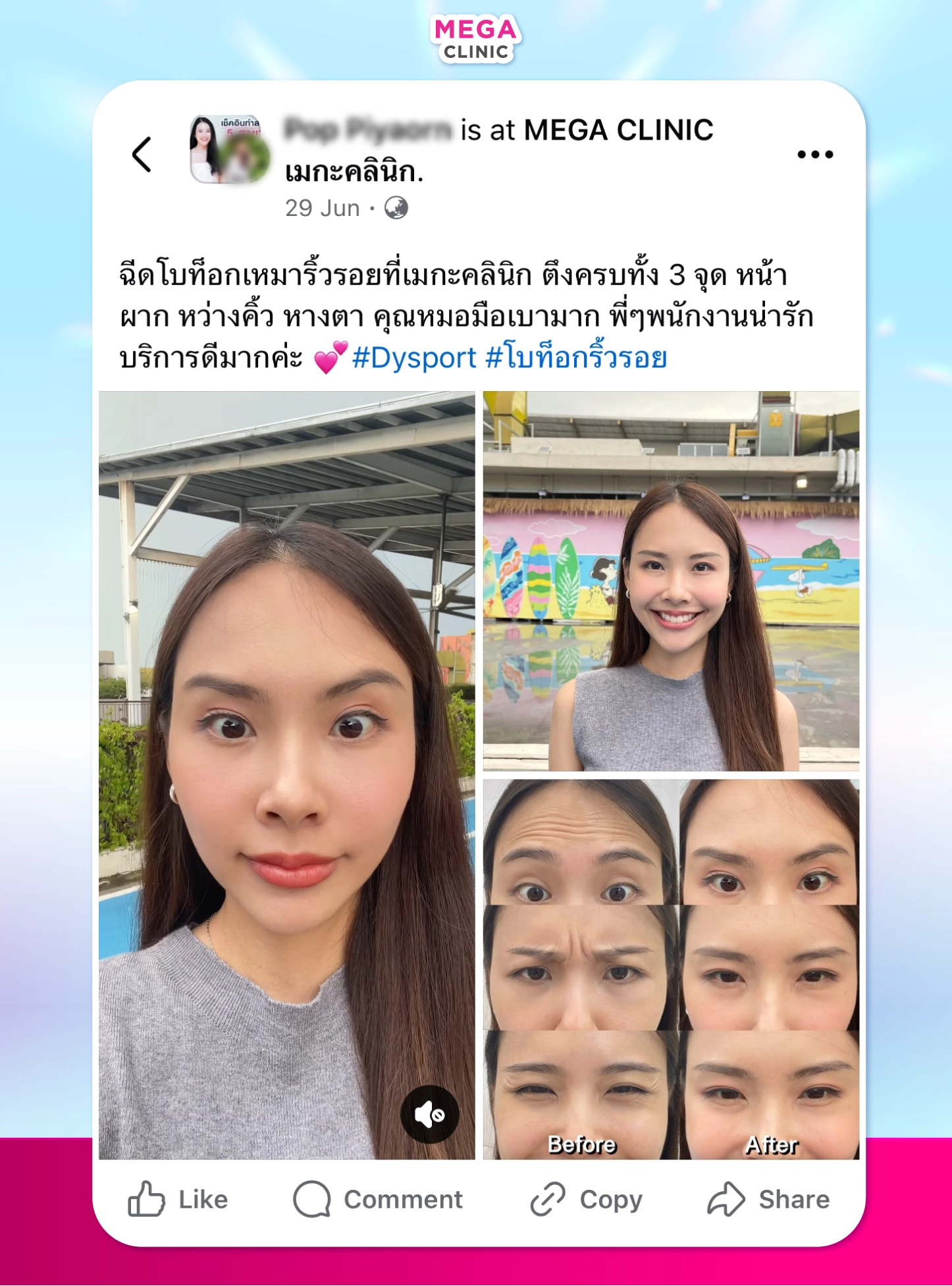 ฉีดโบท็อก รีวิว