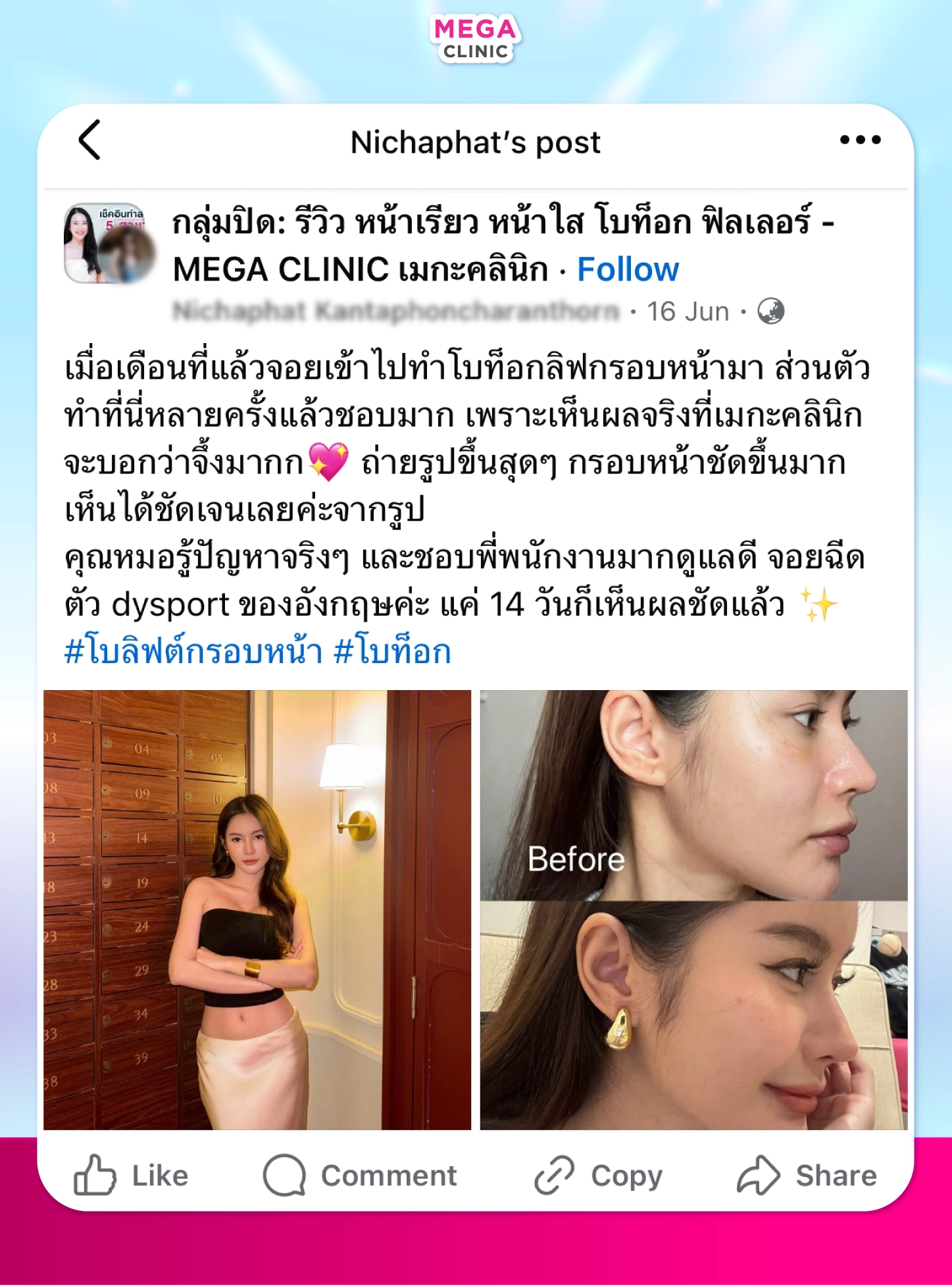 ฉีดโบท็อก รีวิว