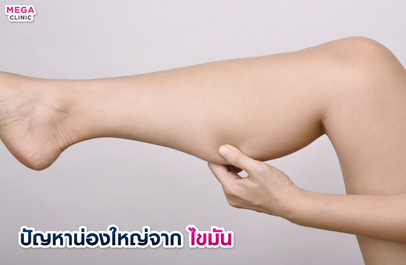 ปัญหาน่องขาใหญ่จากไขมัน