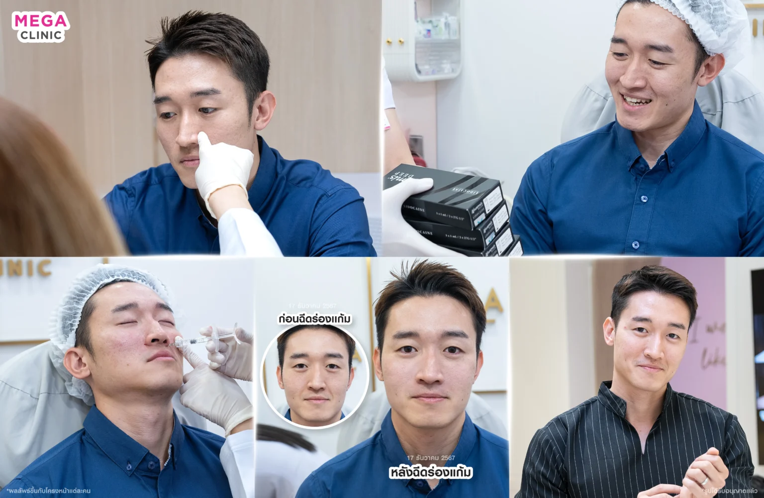 ฉีดฟิลเลอร์ ที่ MEGA CLINIC
