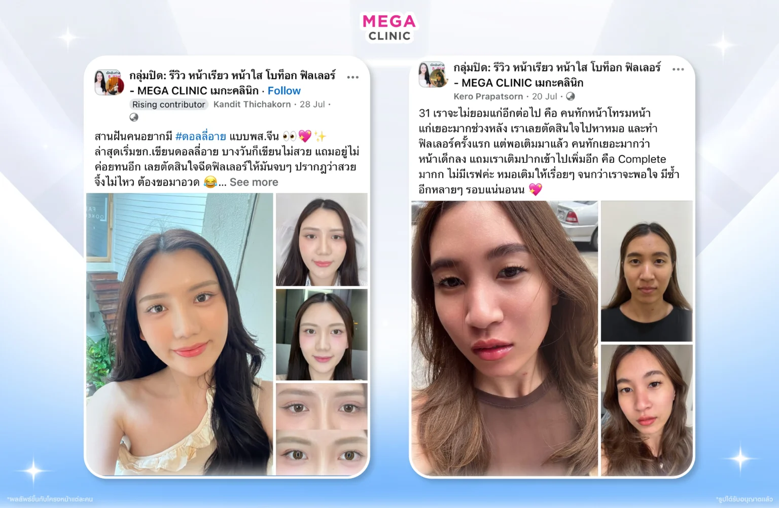 รีวิวฉีดฟิลเลอร์ ที่ MEGA CLINIC