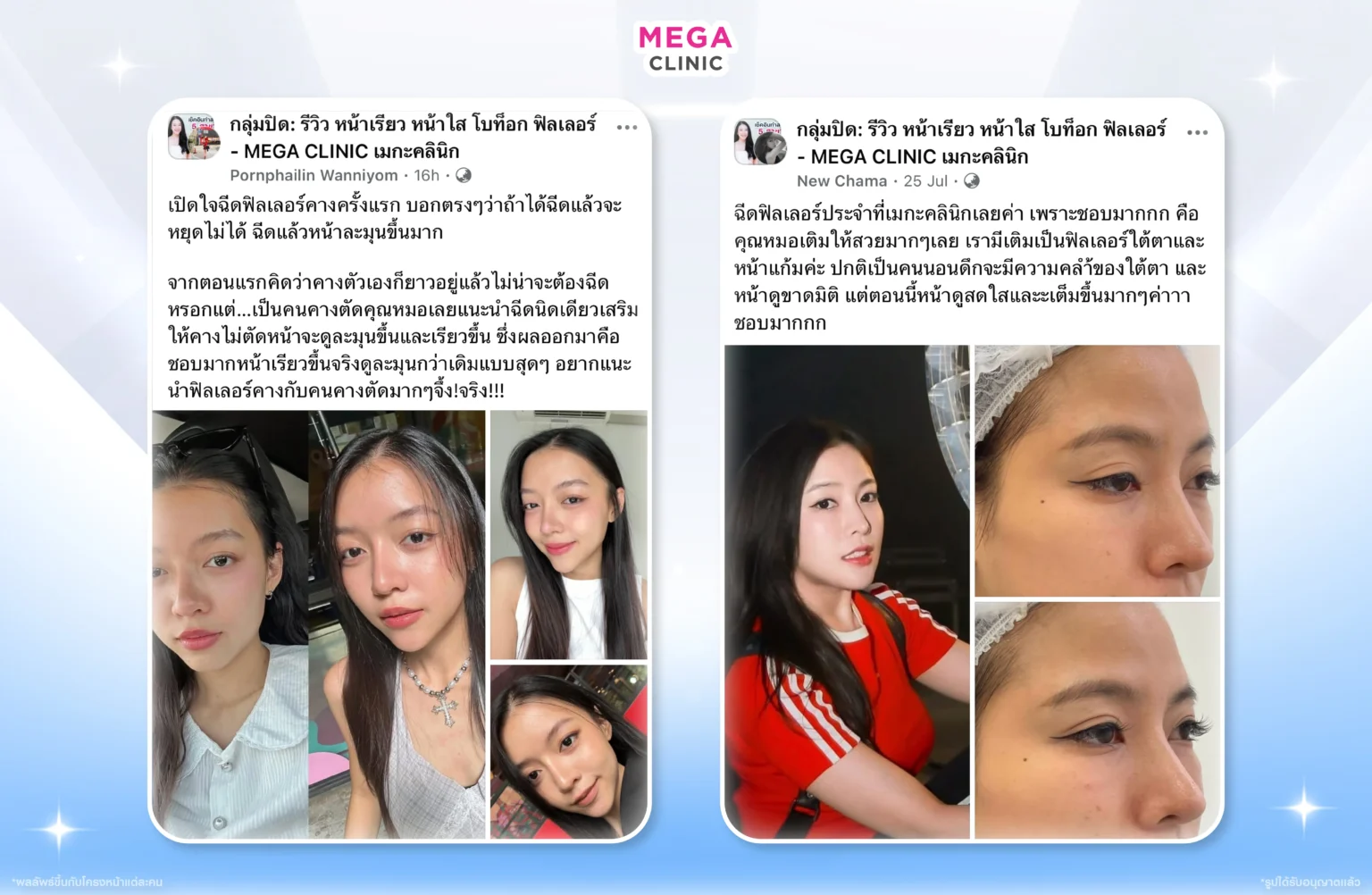 รีวิวฉีดฟิลเลอร์ ที่ MEGA CLINIC