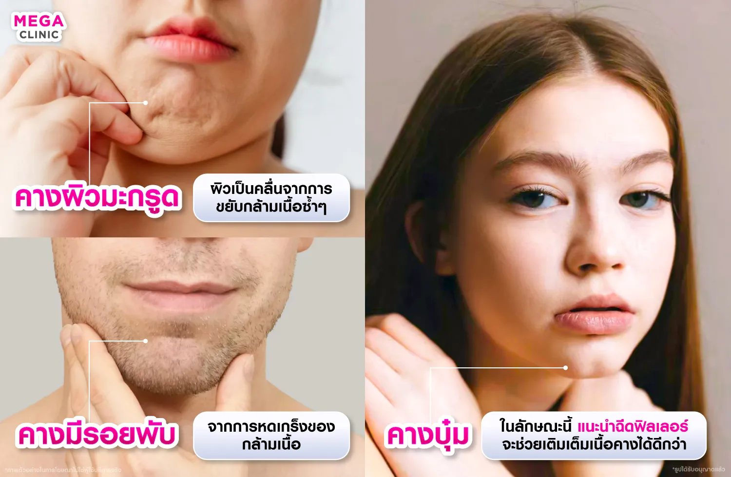 คางย่น คางผิวมะกรูด เกิดจาก