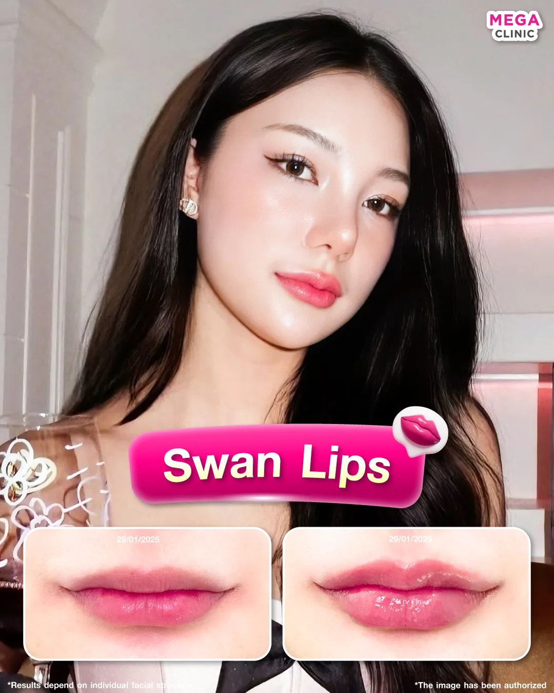 ปากทรง Swan Lips