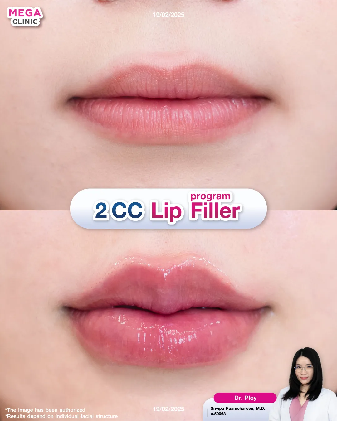 รีวิวฉีดปาก 2 CC