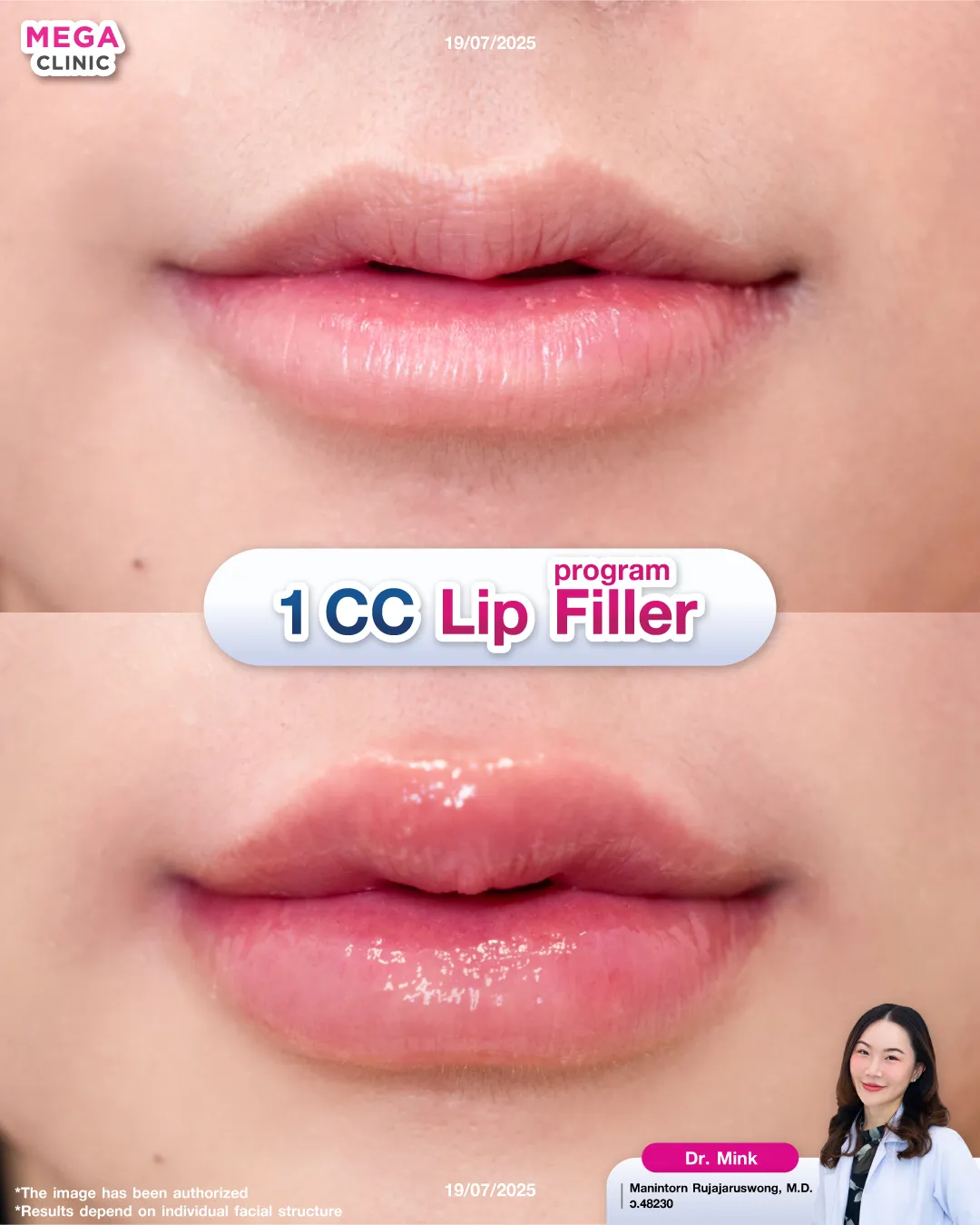 Reviews of 1 CC lip filler
