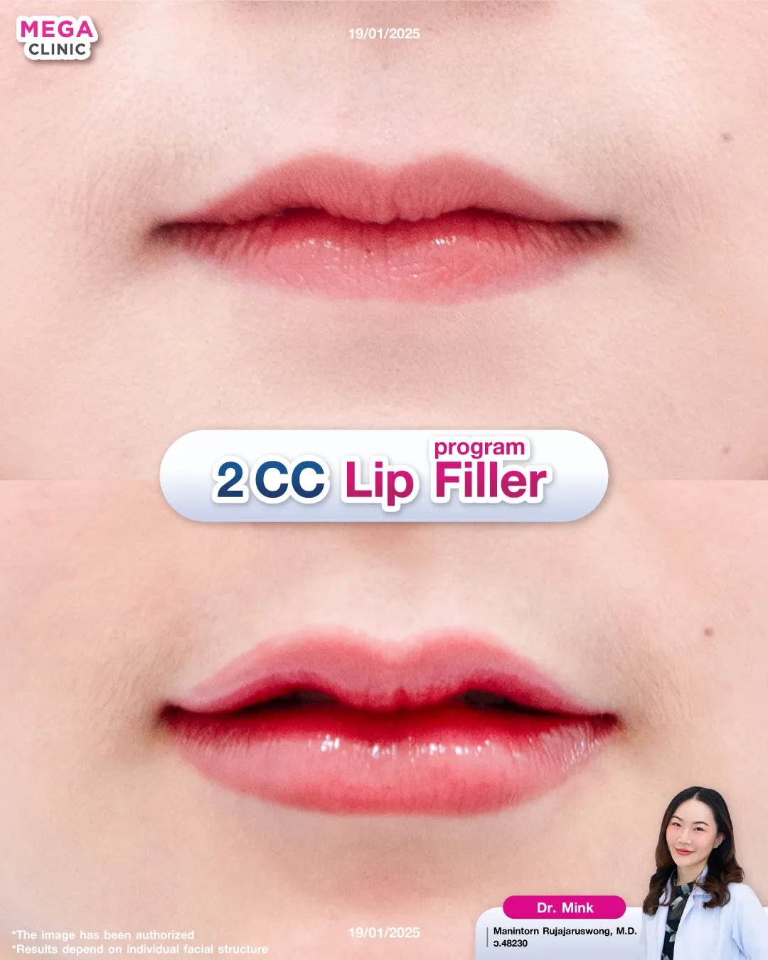 รีวิวฉีดปาก 2 CC