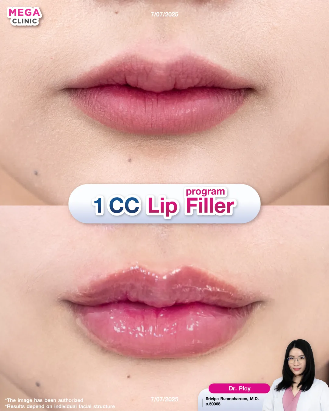 Reviews of 1 CC lip filler
