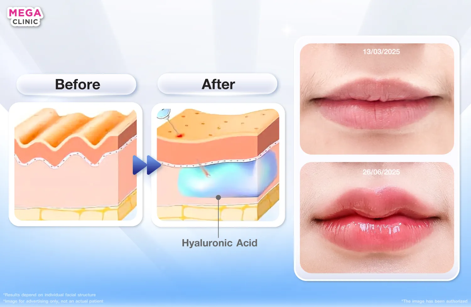 ฟิลเลอร์ปาก คืออะไร