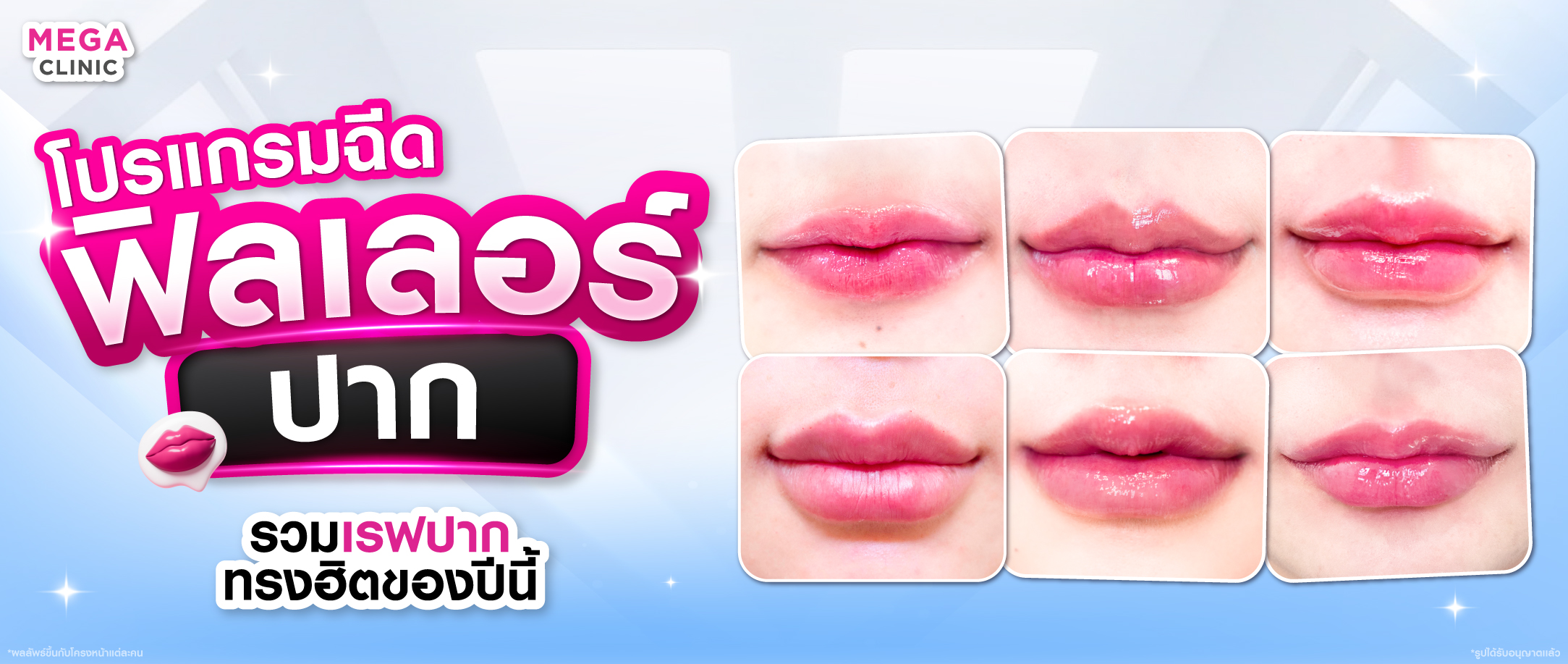 ฟิลเลอร์ปาก คืออะไร