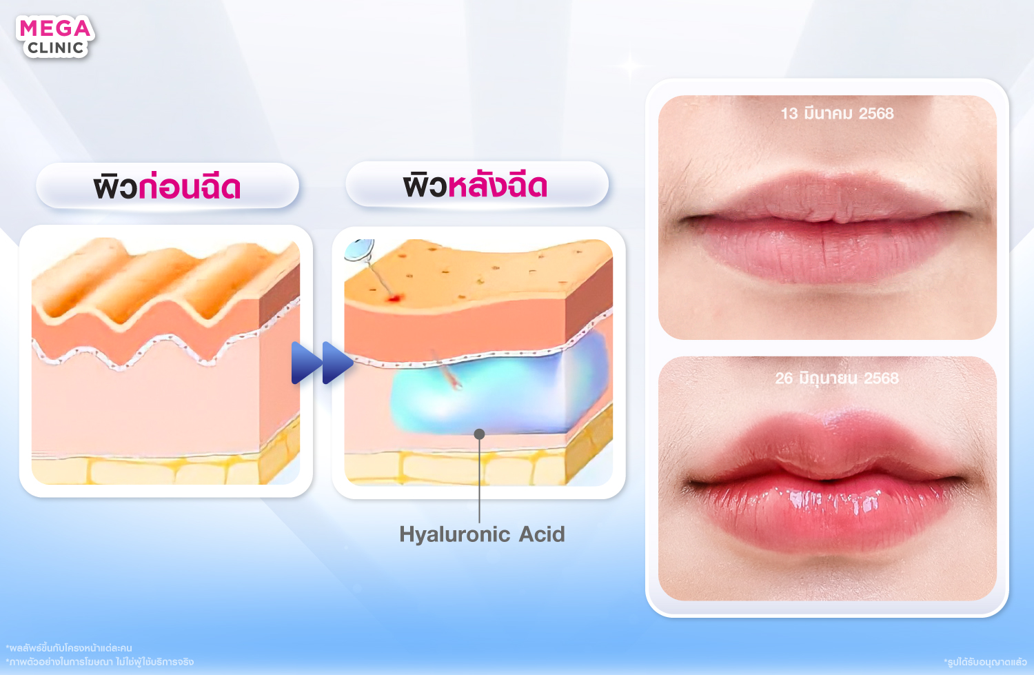 ฟิลเลอร์ปาก คืออะไร