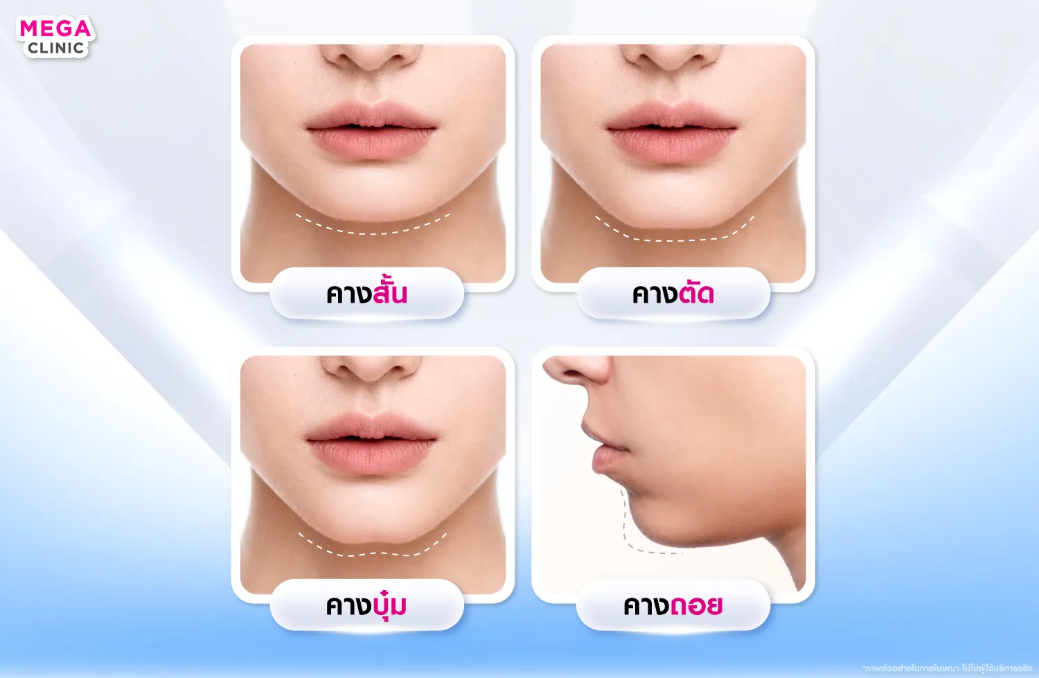 ฟิลเลอร์คางแก้ปัญหาทรงคางสั้น คางตัด คางบุ๋ม คางถอย