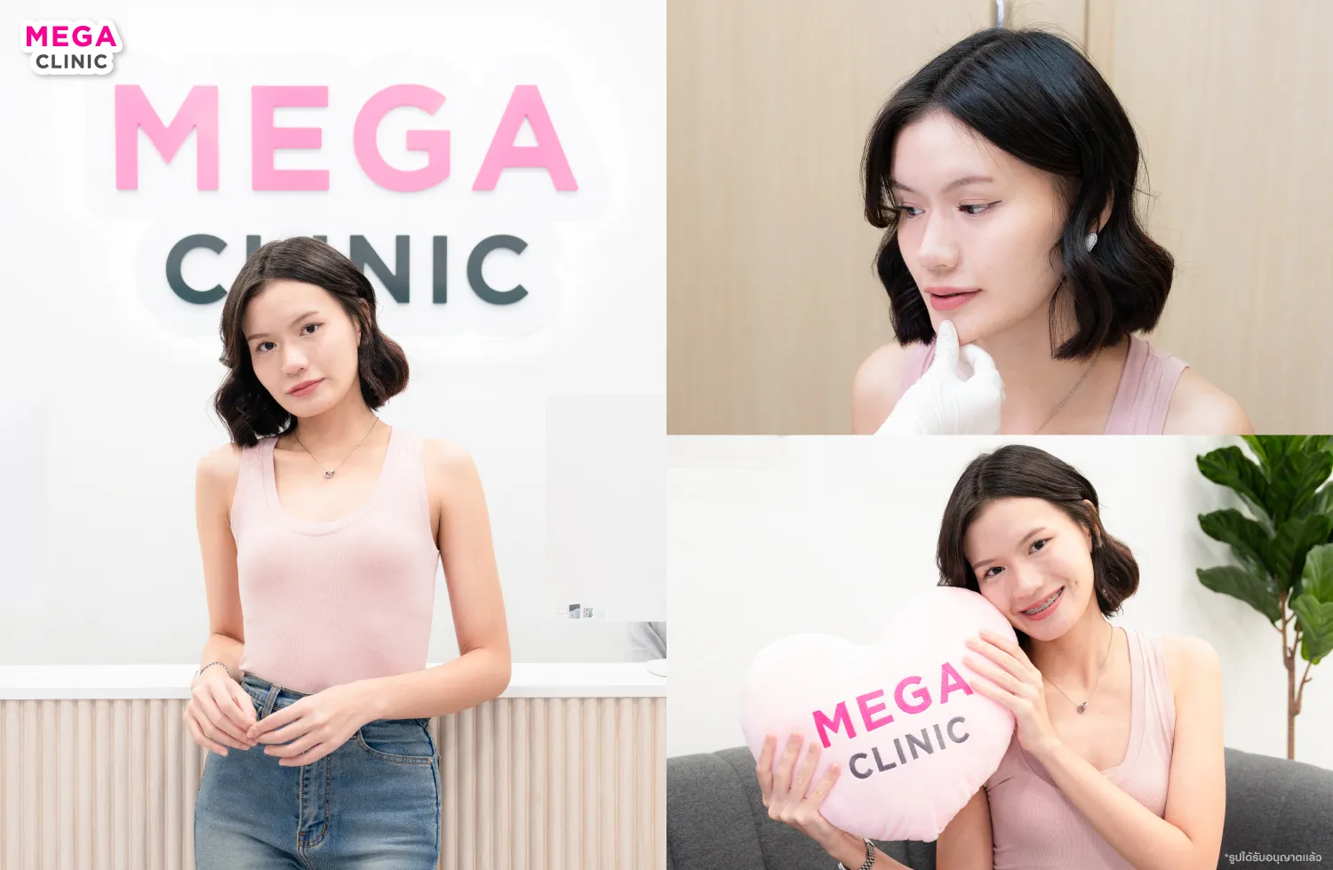 ที่ฟิลเลอร์คาง ที่ MEGA CLINIC สาขา สยามสแควร์ นนทบุรี ลาดพร้าว รังสิตปากน้ำ
