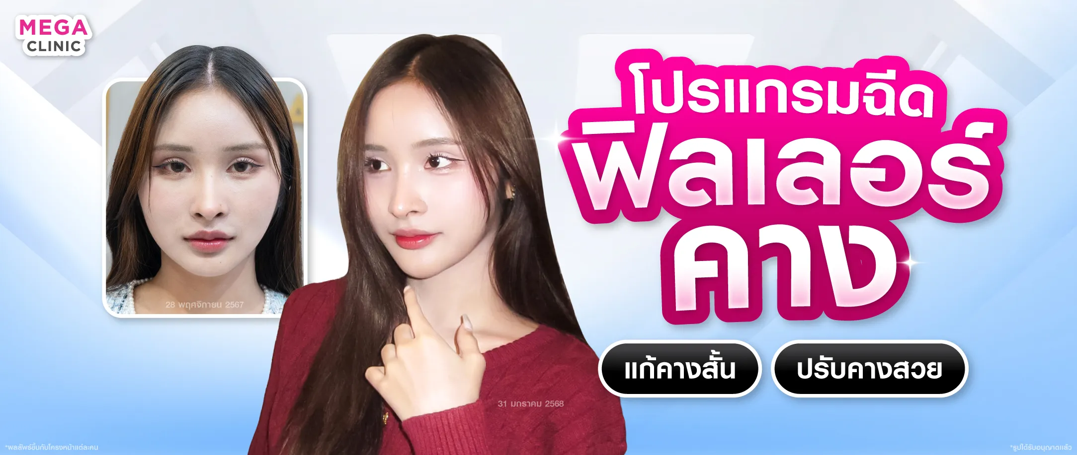 ฟิลเลอร์คาง คืออะไร?
