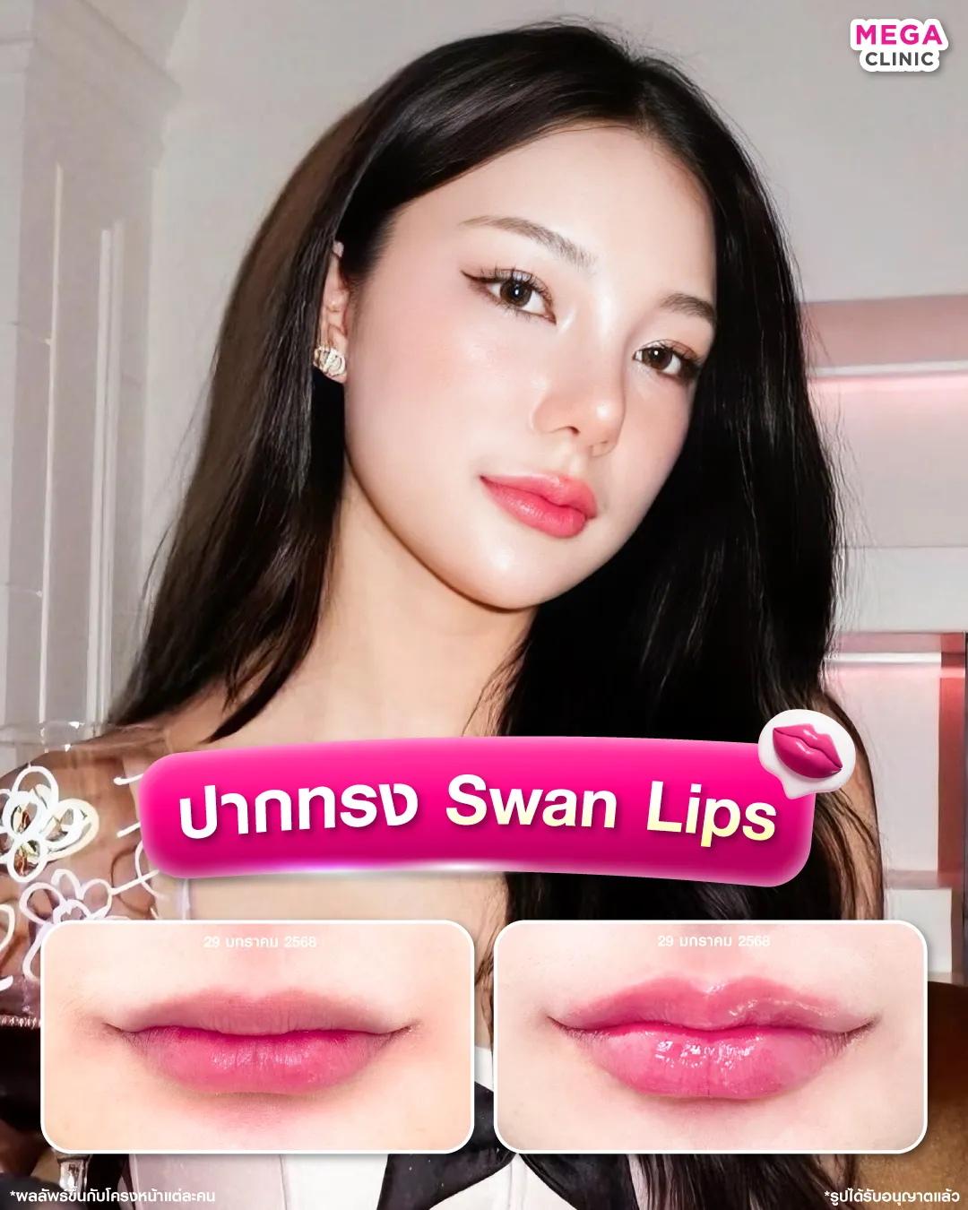 天鹅唇形（Swan Lips）