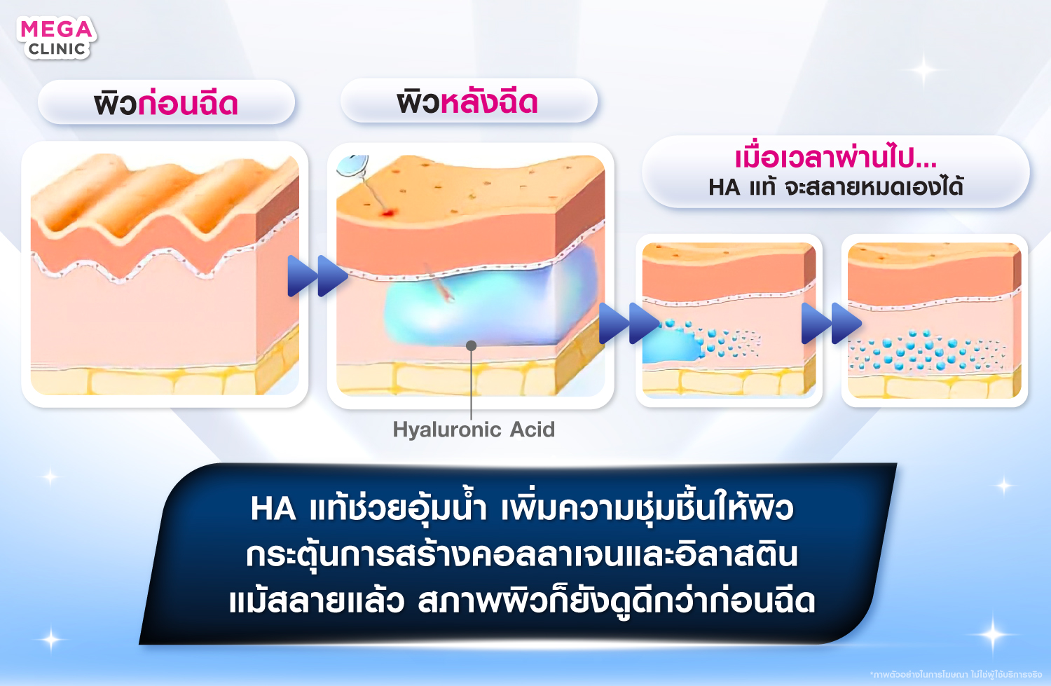 ฟิลเลอร์ คืออะไร