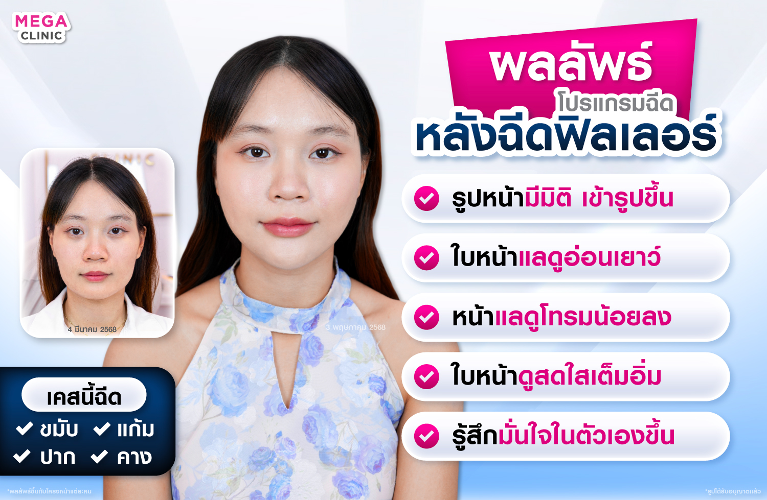 ผลลัพธ์หลังฉีดฟิลเลอร์