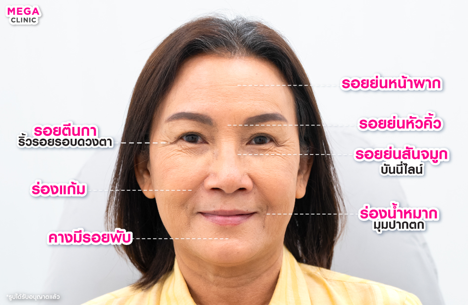 ริ้วรอยคืออะไร