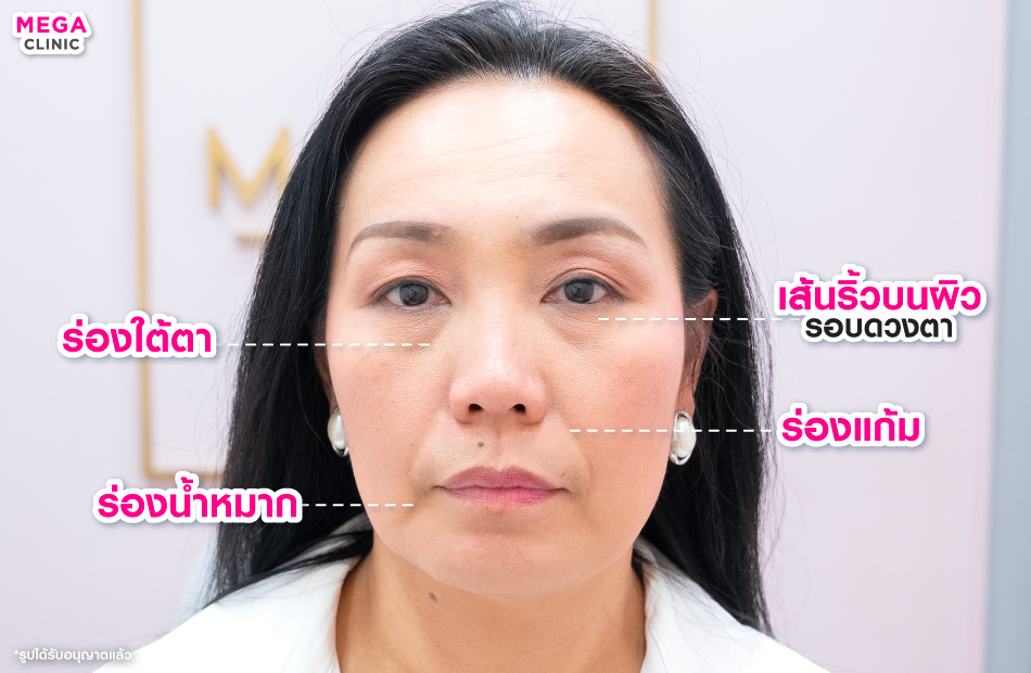 ริ้วรอยบนใบหน้า