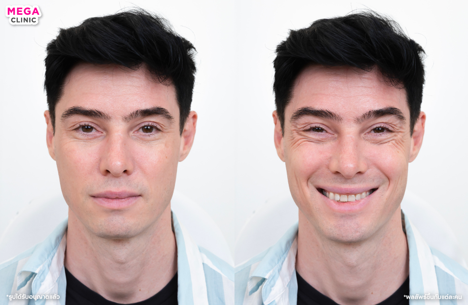 ริ้วรอย เกิดจากอะไร