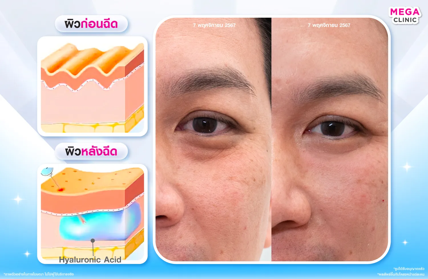 ฟิลเลอร์ใต้ตา คืออะไร