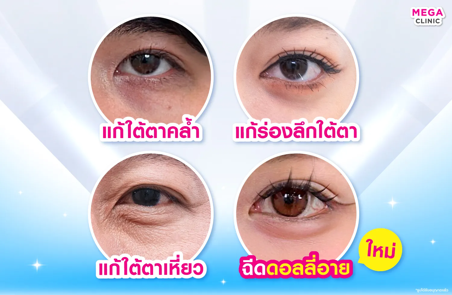 แก้ใต้ตาคล้ำ แก้ร่องลึกใต้ตา แก้ใต้ตาเหี่ยว ฉีดดอลลี่อาย