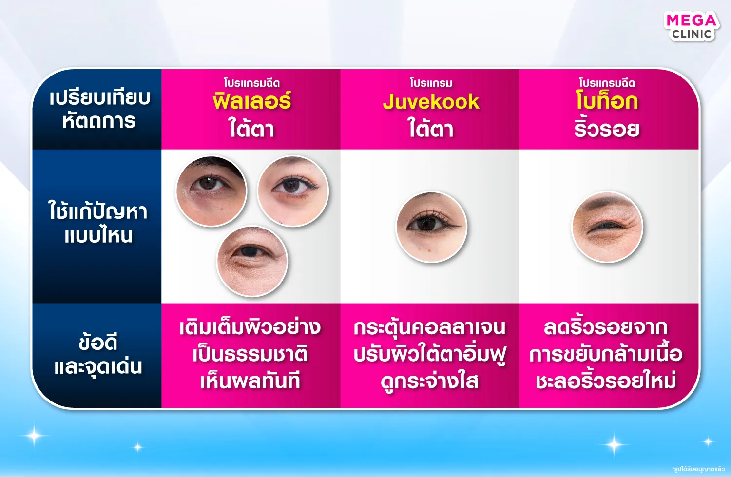 ฟิลเลอร์ใต้ตา Juvelook ใต้ตา โบท็อกริ้วรอย