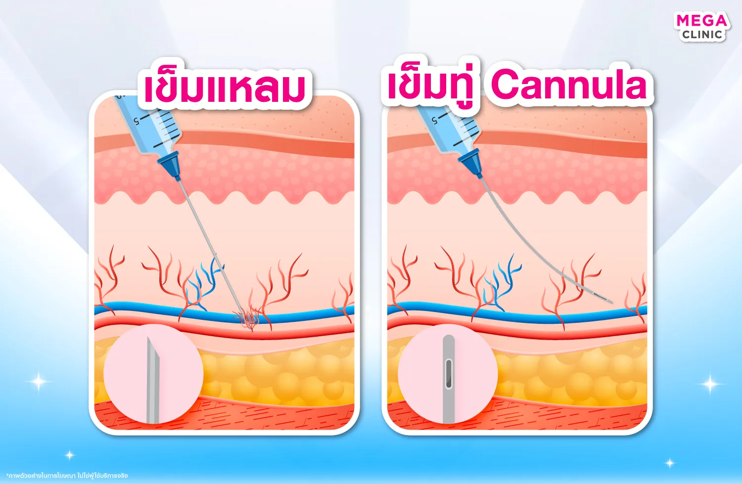 ฉีดฟิลเลอร์ใต้ตาด้วยเข็มแหลม และเข็มทู่