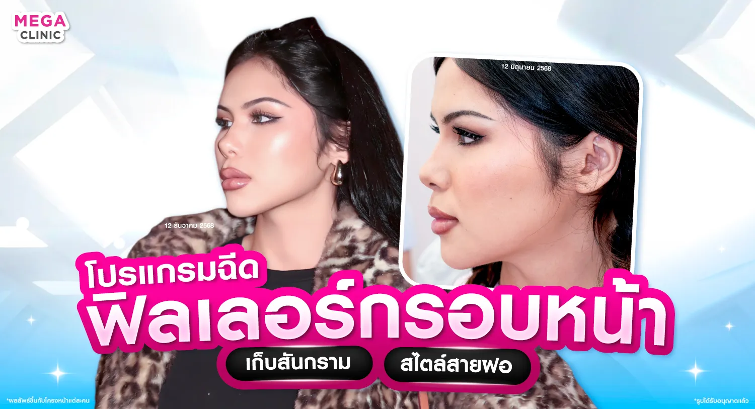 ฟิลเลอร์กรอบหน้า ช่วยลิฟกรอบหน้าที่ไหนดี