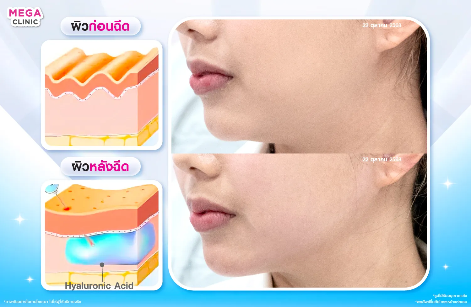 กรอบหน้าชัด ทำไง ฟิลเลอร์กรอบหน้า เพิ่ม Jawline