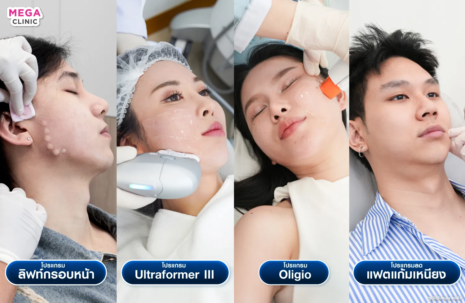 หัตถการเก็บกรอบหน้า ยกกระชับผิว