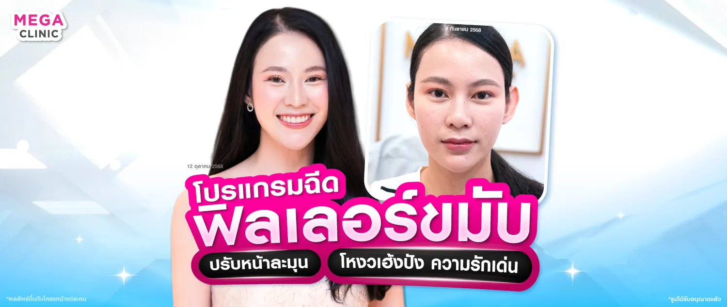 ฟิลเลอร์ขมับ แก้ขมับตอบ โหนกแก้มสูง