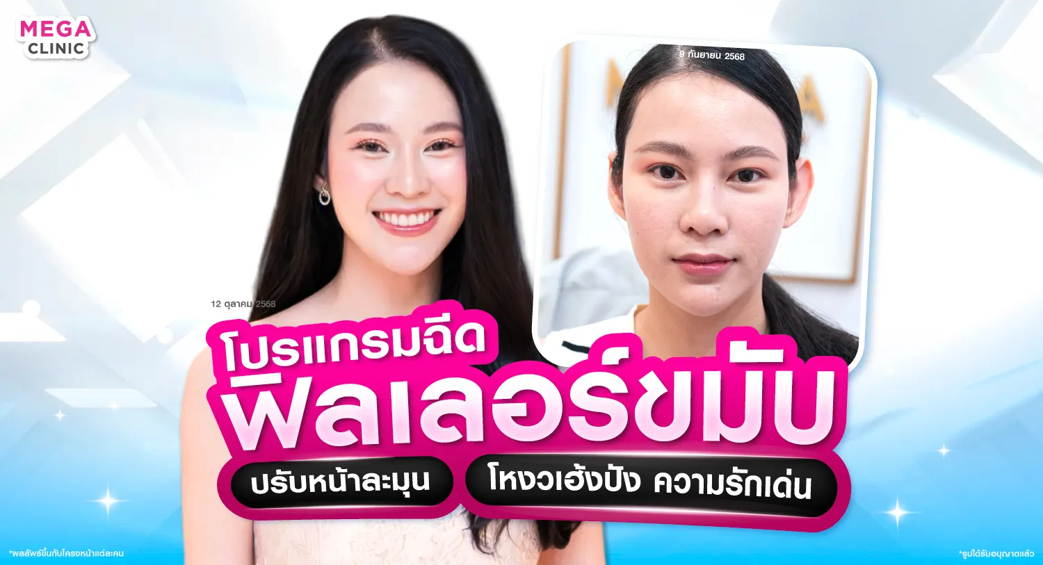 ฟิลเลอร์ขมับ แก้ขมับตอบ โหนกแก้มสูง