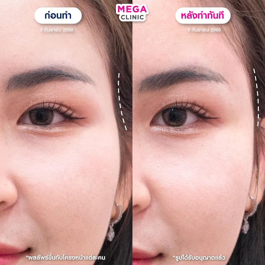 ฟิลเลอร์ขมับ แก้ขมับตอบ โหนกแก้มสูง