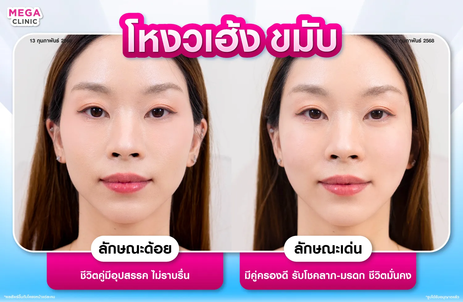 ฟิลเลอร์ขมับ แก้ขมับตอบ โหนกแก้มสูง เสริมโหงวเฮ้ง