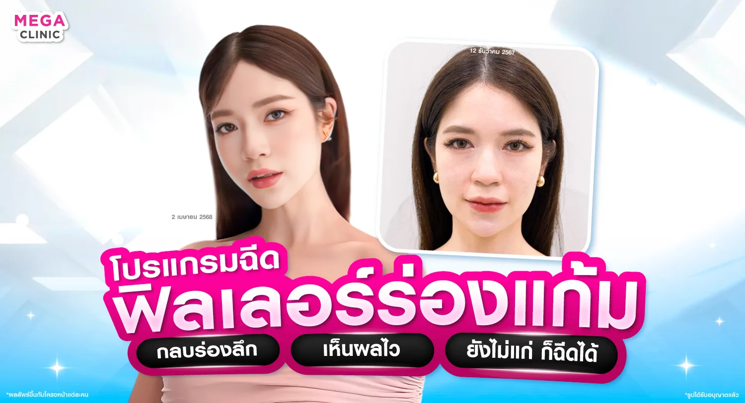 ฟิลเลอร์ร่องแก้ม คืออะไร