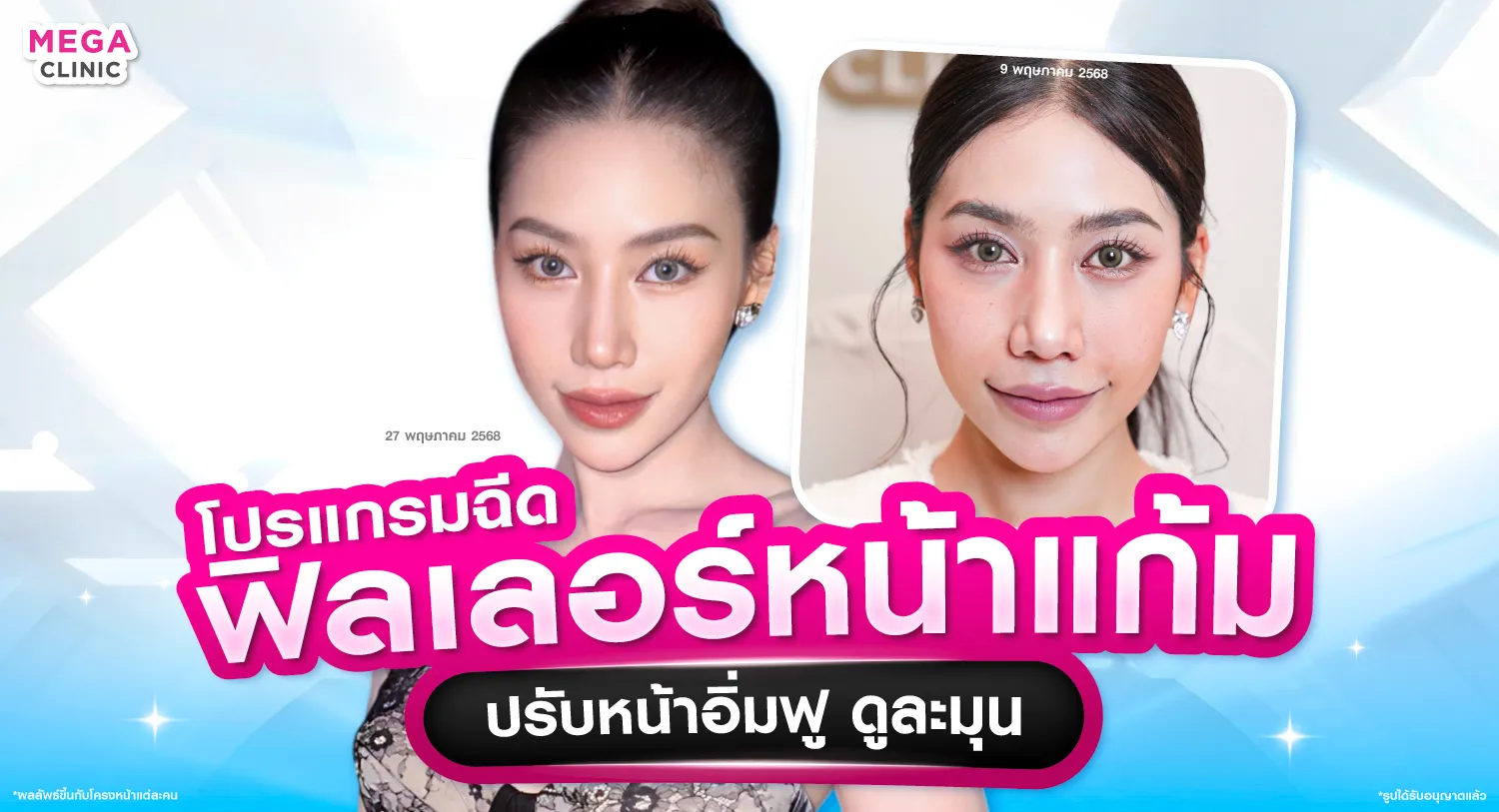 ฟิลเลอร์หน้าแก้ม แก้มส้ม แก้หน้าแบน