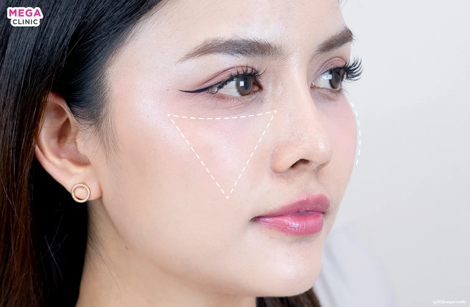 ตำแหน่งของหน้าแก้ม